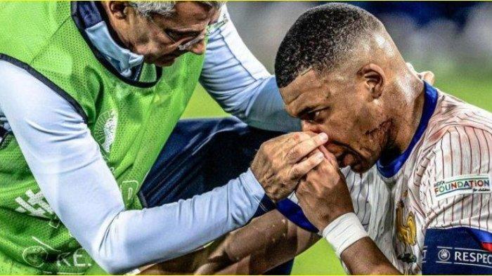 Mbappe Alami Cedera Patah Tulang Hidung Saat Bertanding Lawan Austria